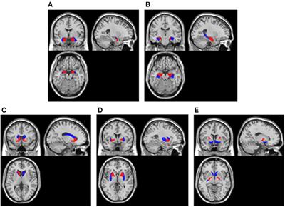 Frontiers | Semi-quantitative FDG-PET Analysis Increases the